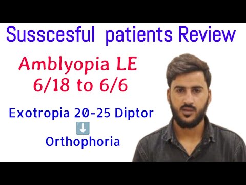 Amblyopia with Esotropia।অলস চোখের চিকিৎসা। आलसी नेत्र उपचारlazy eye exercise।Refocus vision therapy