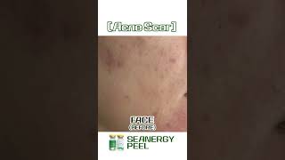 Ultimate Peel Revolution: Clear Acne & Shrink Pores Now!