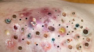 Loan Nguyen Acne Treatment 53c