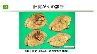 肝臓がん　最近の動向と治療法の選択