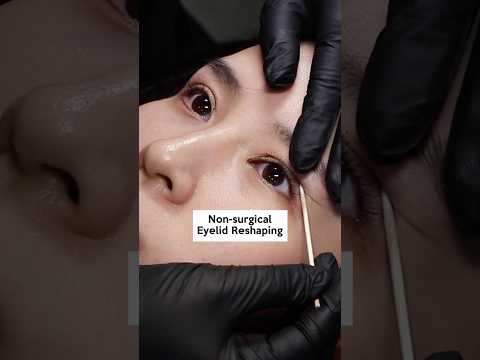 Non-surgical Eyelid Reshaping