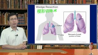 肺癌手术类型：全肺切除如何呼吸？肺叶切除楔形切除节段切除袖状切除