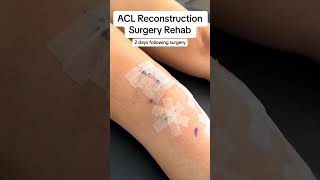 ACL Reconstruction Surgery Rehab: 2 days following acl reconstruction surgery