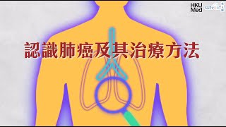 認識肺癌及其治療方法
