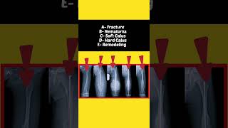 Fracture Bone Healing Process #xray #shorts