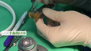 內膜細胞眼角膜移植手術│眼科部 簡鴻仁醫師