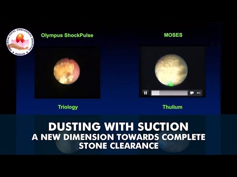 Dusting with suction - a new dimension towards complete stone clearance