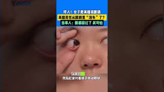 嚇人!女子戴美瞳揉眼睛，美瞳竟從眼睛裏“消失”了  當事人 眼都磨紅了真後怕 #真實事件 #奇聞趣事 #新聞 #shorts