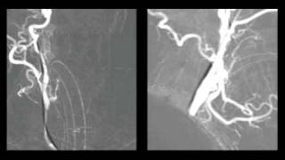 Endovascular Neurosurgery Video