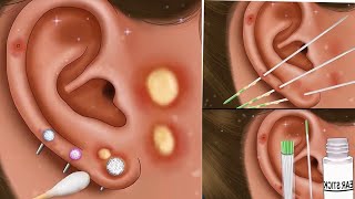ASMR | Part -2 satisfying earwax removal | oddly ear stone removal and cleaner