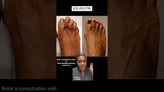 Want to get rid of those toe corns? #footdoctor #podiatrylife #podiatrist