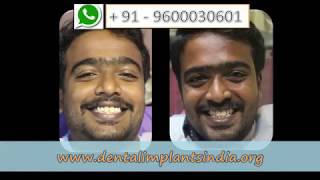New teeth New smile in chennai