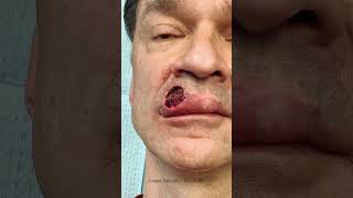 Skin Cancer Case Study: Basal Cell Carcinoma #BasalCellCarcinoma #CaseStudy #Gorlin Syndrome