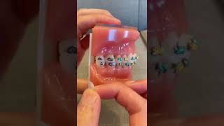 How to Use OrthoDots if Ortho Wax keeps falling off | Dr Bar The Braces Doc