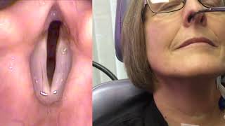 Technique for ABductor botulinum toxin Botox injection