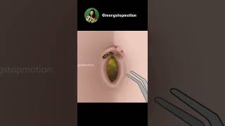 ASMR Oddly Satisfying Remove Huge Navel Stone | Navel cleaning | piercing removal #animation