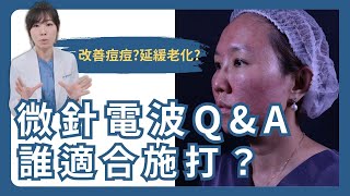 能改善青春痘也能延緩老化！哪些人適合施打墨菲斯電波？
