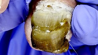 Toenails Grow In Three Layers, Remove The Black Dirt!【Pedicure King】