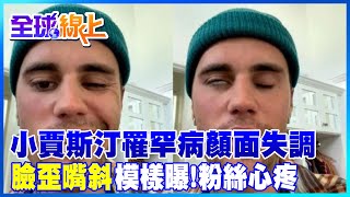 小賈斯汀臉歪嘴斜模樣曝光 罹罕病顏面神經失調!巡演急喊卡@全球大視野Global_Vision