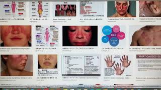全身性エリテマトーデス(SLE)の概要