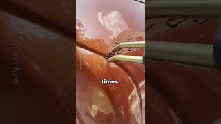 How is a bumper repaired with plastic welding!?