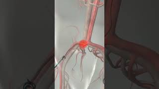 Learn How Cardiac Catheterization Works