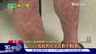 皮膚脫皮.脫屑 出現「這狀況」..醫警告:皮膚淋巴癌機率增｜十點不一樣20220712