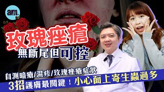 玫瑰痤瘡無斷尾但可控 自測暗瘡/濕疹/玫瑰痤瘡症狀 用錯方法醫慘變爛面｜3招護膚最關鍵！不建議用冰敷冷敷紓緩紅腫｜醫Sick醫識［CC字幕］#玫瑰痤瘡 #暗瘡 #濕疹 #皮膚科 #皮膚病 #am730