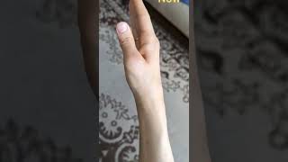 Before and After Rheumatoid Arthritis - Aljona's Wrists