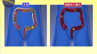 治る最前線「潰瘍性大腸炎の最新治療」