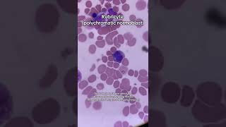 It’s a twin! Rubricyte in mitosis. #medlab #clinicallaboratory #laboratory #laboratorio #medicallab