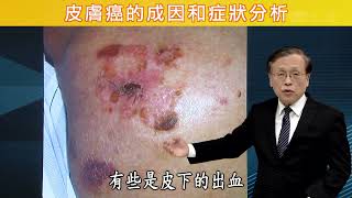 【皮膚癌的成因和症狀分析】【大愛醫生館精選】