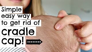 HOW TO GET RID OF CRADLE CAP IN ONE TRY! || NEWBORN