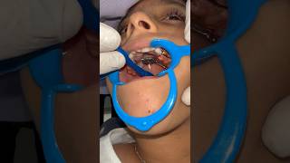 Hyrax Arch expander: Creating space for a beautiful, aligned smile. #expansion #orthodontist #wow