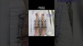 猿でもわかる骨延長 #骨延長 #身長 #leglengthening #limblengthening #shorts