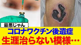 コロナワクチン後遺症生涯治らない模様…【2chまとめ】【2chスレ】【5chスレ】