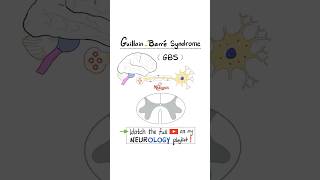ギランバレー症候群（GBS）（急性炎症性脱髄性多発根神経炎-AIDP）
