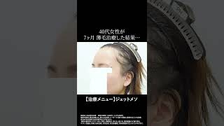 #ジェットメソ　#薄毛治療　#スピロノラクトン　#湘南agaクリニック