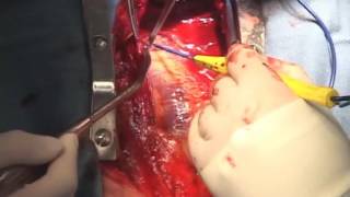 Heart Bypass Surgery