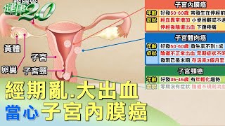 經期亂、大出血 當心子宮內膜癌 健康2.0