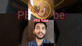 PEG Tube