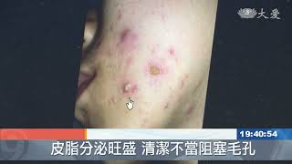 流汗.毛孔油膩狂冒痘 清淡飲食適度清潔