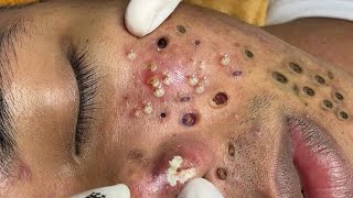 Blackheads Removal | Acne Treatment and Very Satisfying Satisfying Pimple pop 鼻角栓,ピンセット,피지제거_