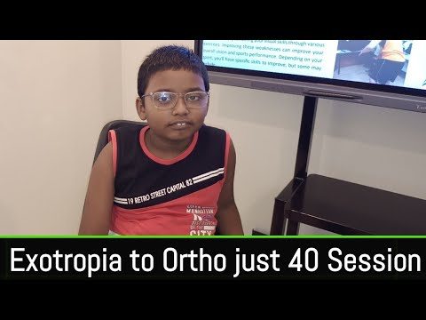 Squint Eye বাকা চোখ বা ট্যারা চোখের চিকিৎসা।तारा नेत्र उपचार।Exotropia Management just 40 session।