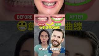 為什麼我矯正器位置很靠牙齦？笑齦+開咬怎麼改？微笑曲線#牙齒矯正#戴牙套