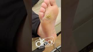How to treat PLANTAR WARTS! #shorts