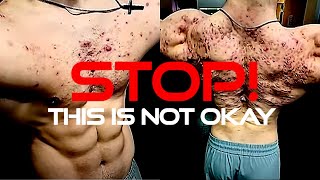Worst Steroid Acne You’ll Ever See