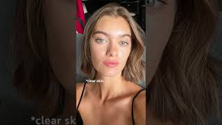 Acne or not you are beautiful 🫶🏻💖#acne #acnetips #acnetreatment #skincare #skintips