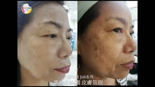 奧兒/讚棒團隊 皮膚管理 | 天麗生技 Joli系列 美麗蛻變分享篇 ：春草（宥嫻阿母））