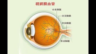 突然看不見當心眼中風 三高族群是高危險群